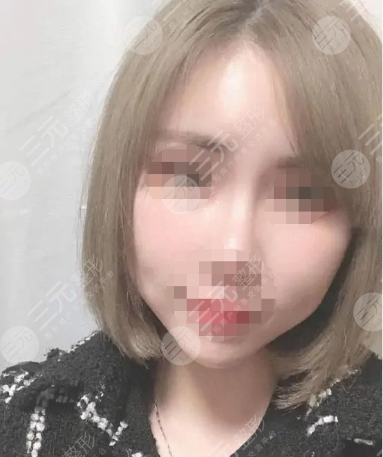 五v明星是埋线除皱?知识科普来喽！附真人案例！