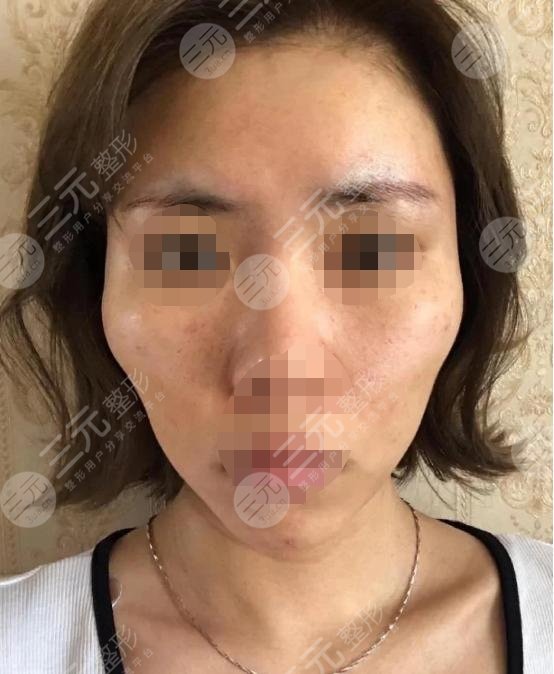 五v明星是埋线除皱?知识科普来喽！附真人案例！