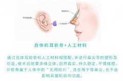 鼻尖整形美容手术价格，有几种方法？术后注意事项