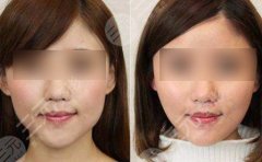 注射瘦脸有果之后就没有咬肌了？有期是多久？