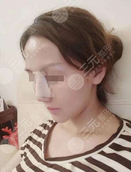 田启明医生隆鼻案例后一周