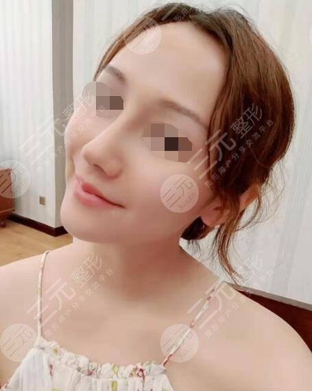 田启明医生隆鼻案例后2周