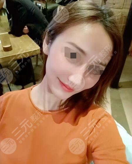 田启明医生隆鼻案例后4周