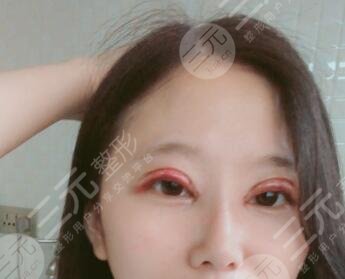 田启明医生双眼皮案例后一周