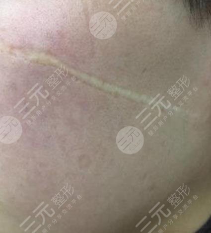 遵义医学院附属医院整形祛疤案例