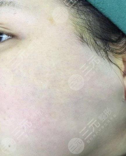 遵义医学院附属医院整形祛疤案例