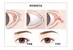 如何开眼角整容？怎么护理不留疤？开眼角步骤
