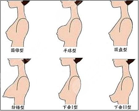 乳房下垂形状