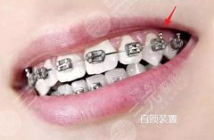 有点龅牙怎么办？不想带牙套就要手术吗？