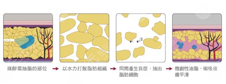火凤凰微创溶脂原理