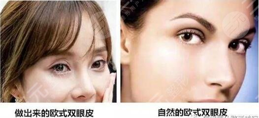 欧式全切双眼皮可以修复吗