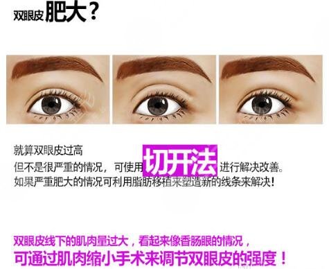欧式全切双眼皮怎么修复
