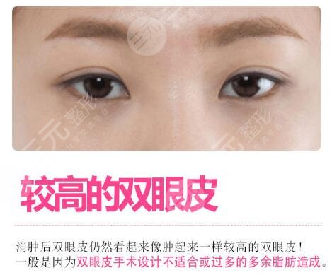 欧式全切双眼皮怎么修复