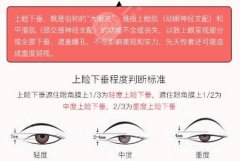 上眼皮松弛矫正术价格|后遗症|恢复图片
