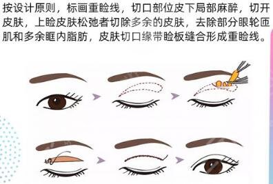 全切双眼皮手术