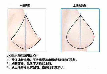 隆胸水滴好还是圆形好