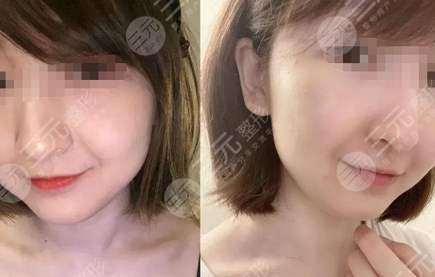 热玛吉做一次可以保持多久