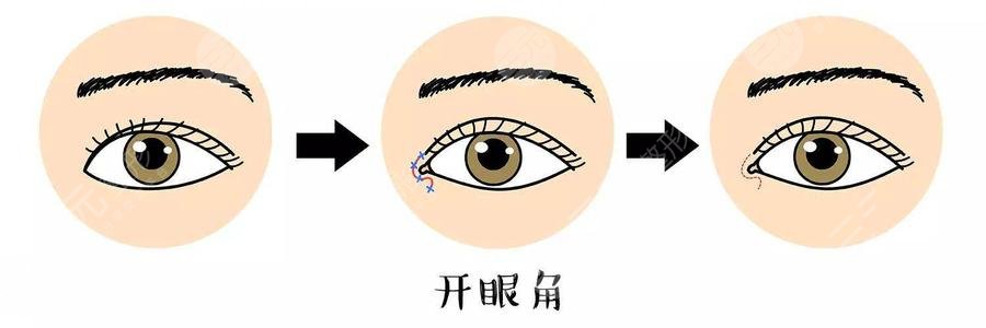 开眼角术后护理