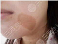 医院激光祛斑果怎样？多少钱1次，能刷医保卡吗？