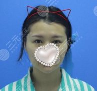 火凤凰溶脂有果吗？图片分享，面部溶脂的好办法！