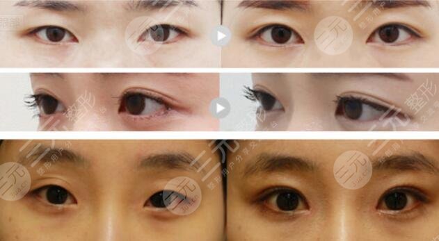 双眼皮开眼角和不开的区别图
