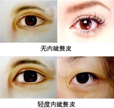 双眼皮开眼角和不开的区别图