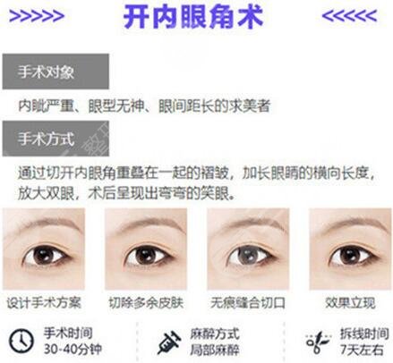 怎么样开眼角