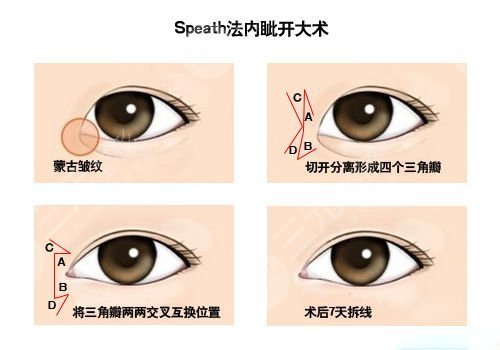 怎么样开眼角