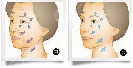 怎样预防面部皱纹?