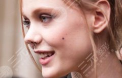 点痣留疤怎么补救？激光点痣一定会留疤吗？