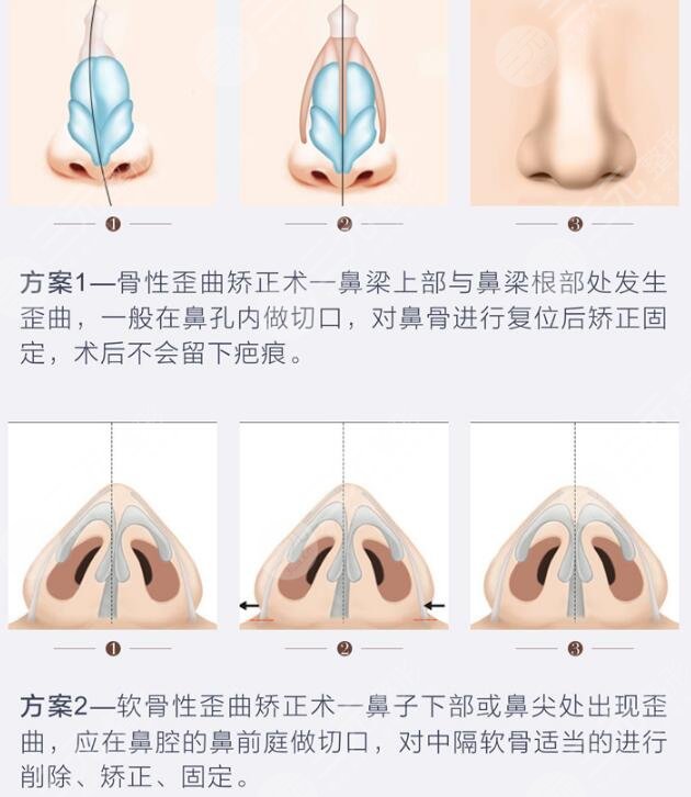 歪鼻矫正的方法