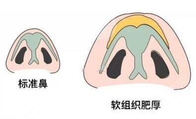 鼻头肥大
