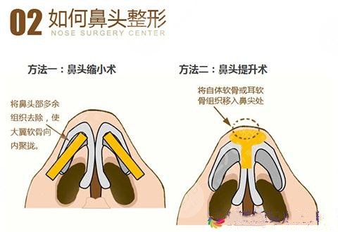 缩小鼻头