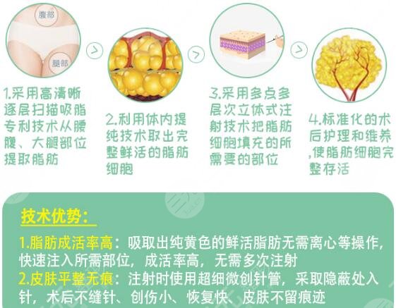 自体脂肪填充隆鼻的优点