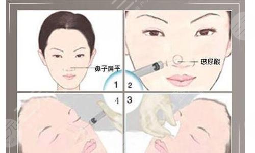 注射隆鼻后如何护理?