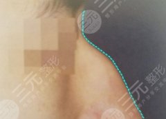 隆鼻手术后遗症大吗?隆鼻术后疼怎么办? 隆鼻手术后遗症大吗?隆鼻术后疼怎么办?