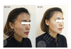 彩光嫩肤手术多少钱一次？多久做一次？mz吗？