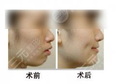 酒窝整形价格6000贵吗，不笑的时候会有坑吗？