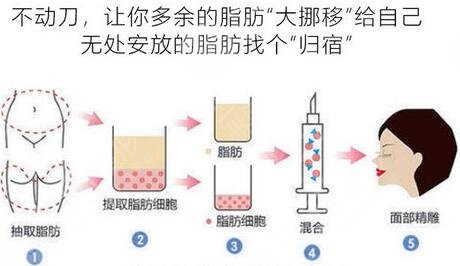 自体脂肪面部填充术价格