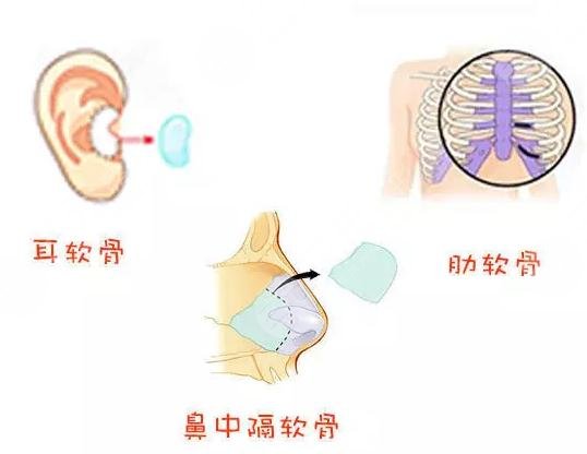 自体软骨从哪里取