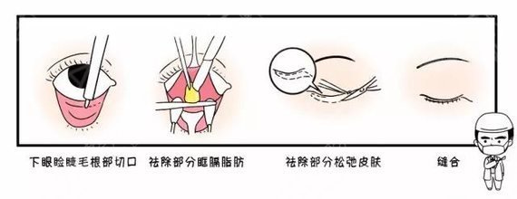 外路法切除下眼袋