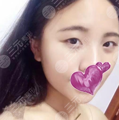 杭州117医院整形科割双眼皮案例