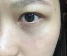 整容去眼袋会留疤痕吗？手术去眼袋适合人群