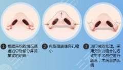 鼻尖缩小术会呼吸困难吗？手术是怎么做的？