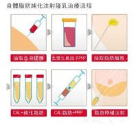 脂肪隆胸术后注意事项,价格多少,有关术后结节 脂肪隆胸术后注意事项,价格多少,有关术后结节