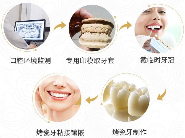 烤瓷牙能用多久