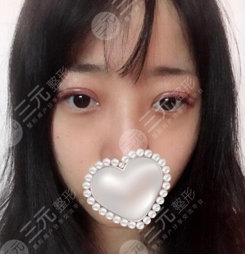 袁希割双眼皮图