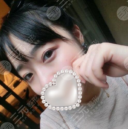 袁希割双眼皮图