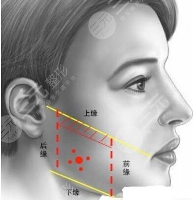 咬肌切除手术价格是多少?手术的注意事项|咬肌切除案例