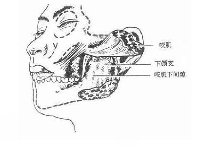 咬肌切除手术价格是多少?